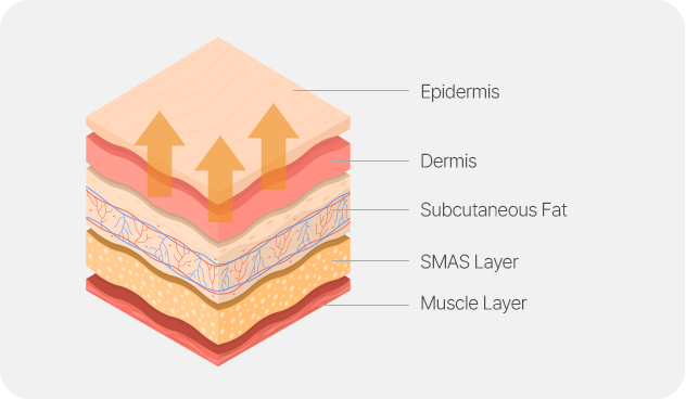 Traditional Facelift