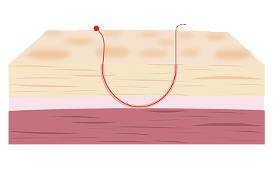 Fixation Illustration